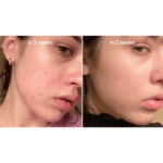 سرم-ضد-لک-نیاسینامید-10-ترانگزامیک-اسید-4-آنوا-Anua-Niacinamide-10-TXA-4-Dark-Spot-Correcting-Serum-2-min